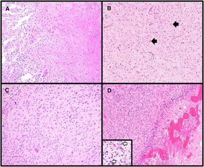 Pediatric brain tumors: A neuropathologist's approach to the integrated diagnosis